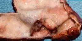 GALLBLADDER INTRAEPITHELIAL NEOPLASIA