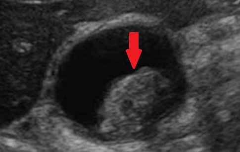 MALIGNANT GALLBLADDER POLYP
