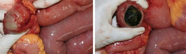 GALLSTONE ILEUS