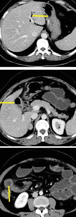 GALLSTONE ILEUS