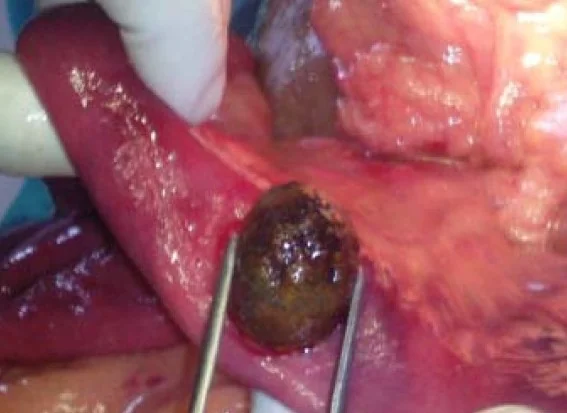 GALLSTONE ILEUS