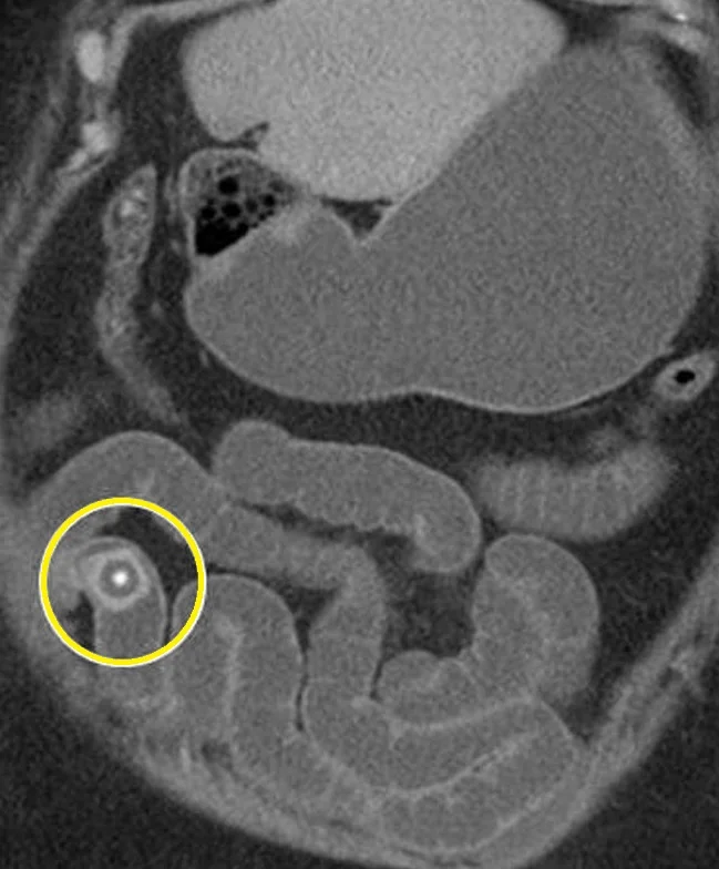 GALLSTONE ILEUS