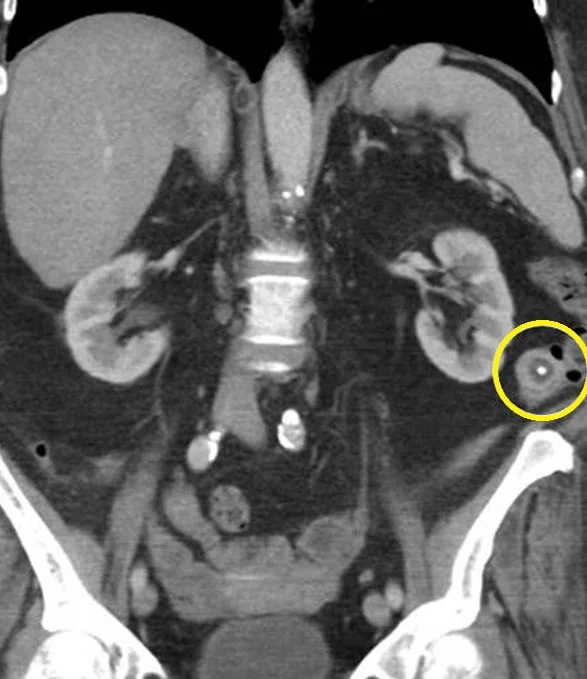 GALLSTONE ILEUS