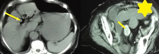 GALLSTONE ILEUS - RIGLER'S TRIAD