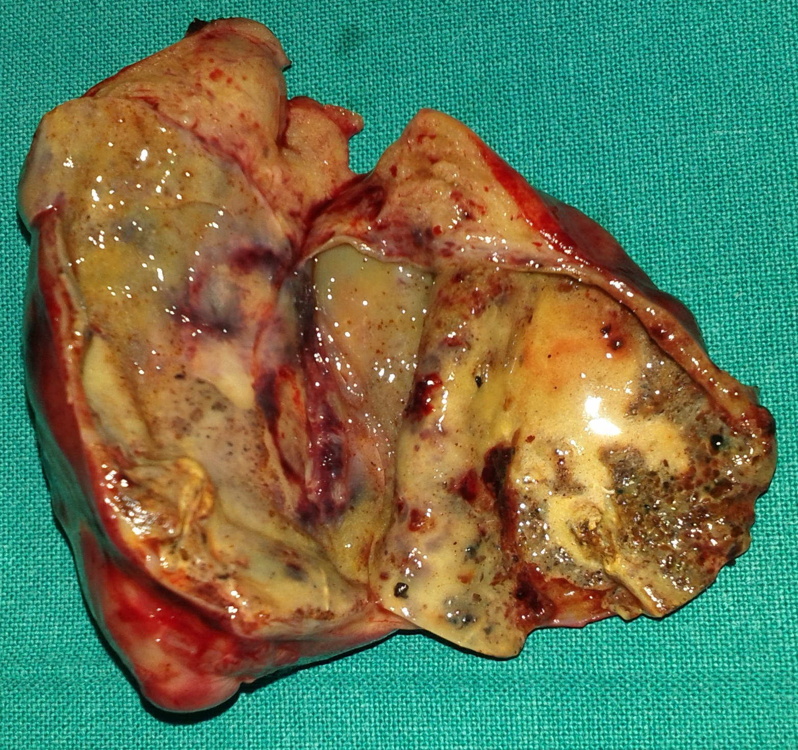 GALLBLADDER CARCINOMA