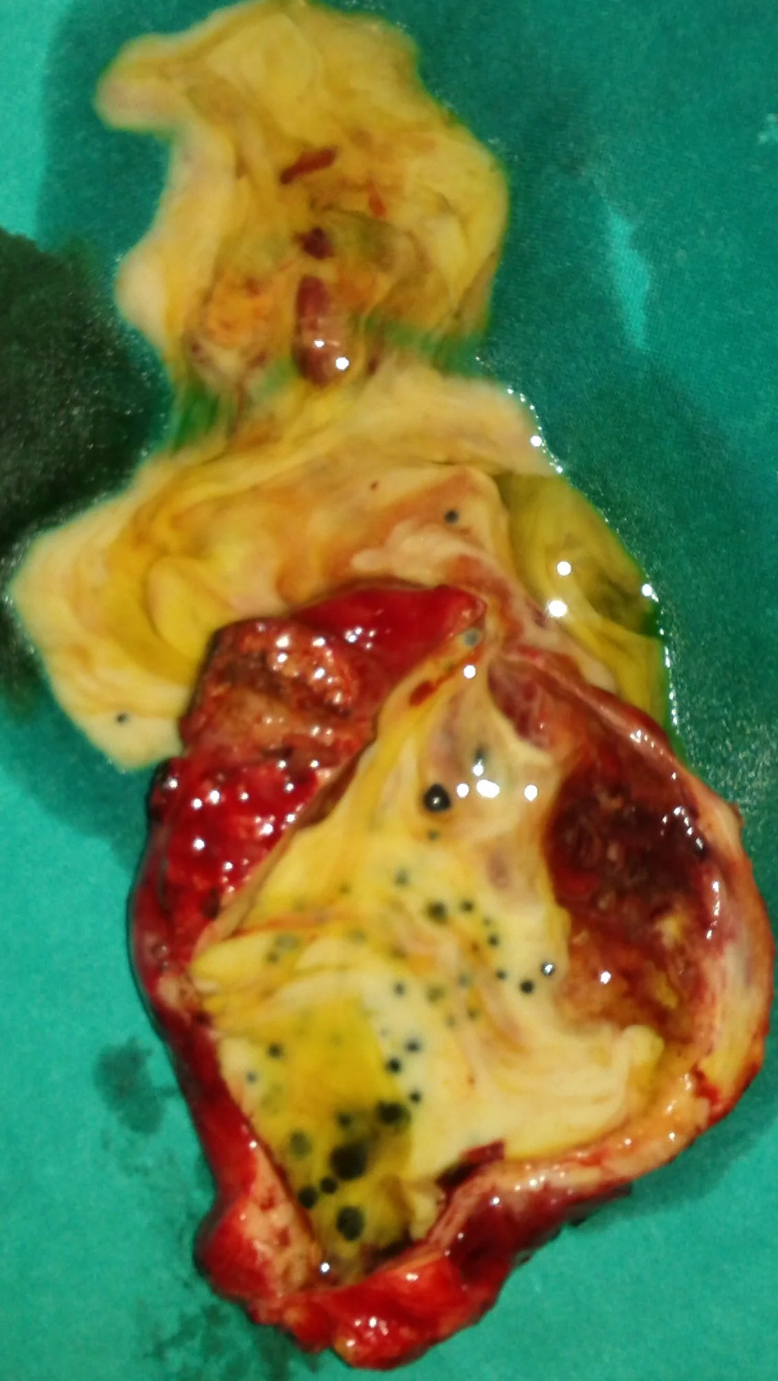 GALLBLADDER EMPYEMA