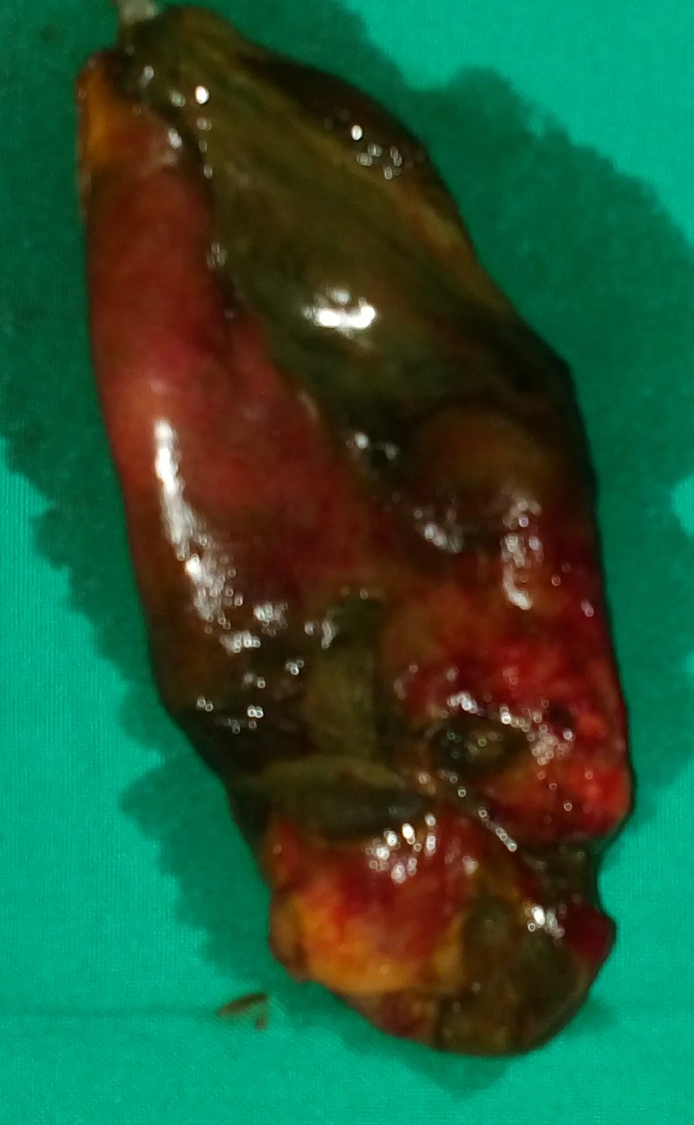 GALLBLADDER NECROSIS