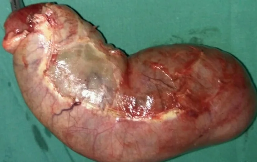 GALLBLADDER HYDROPS