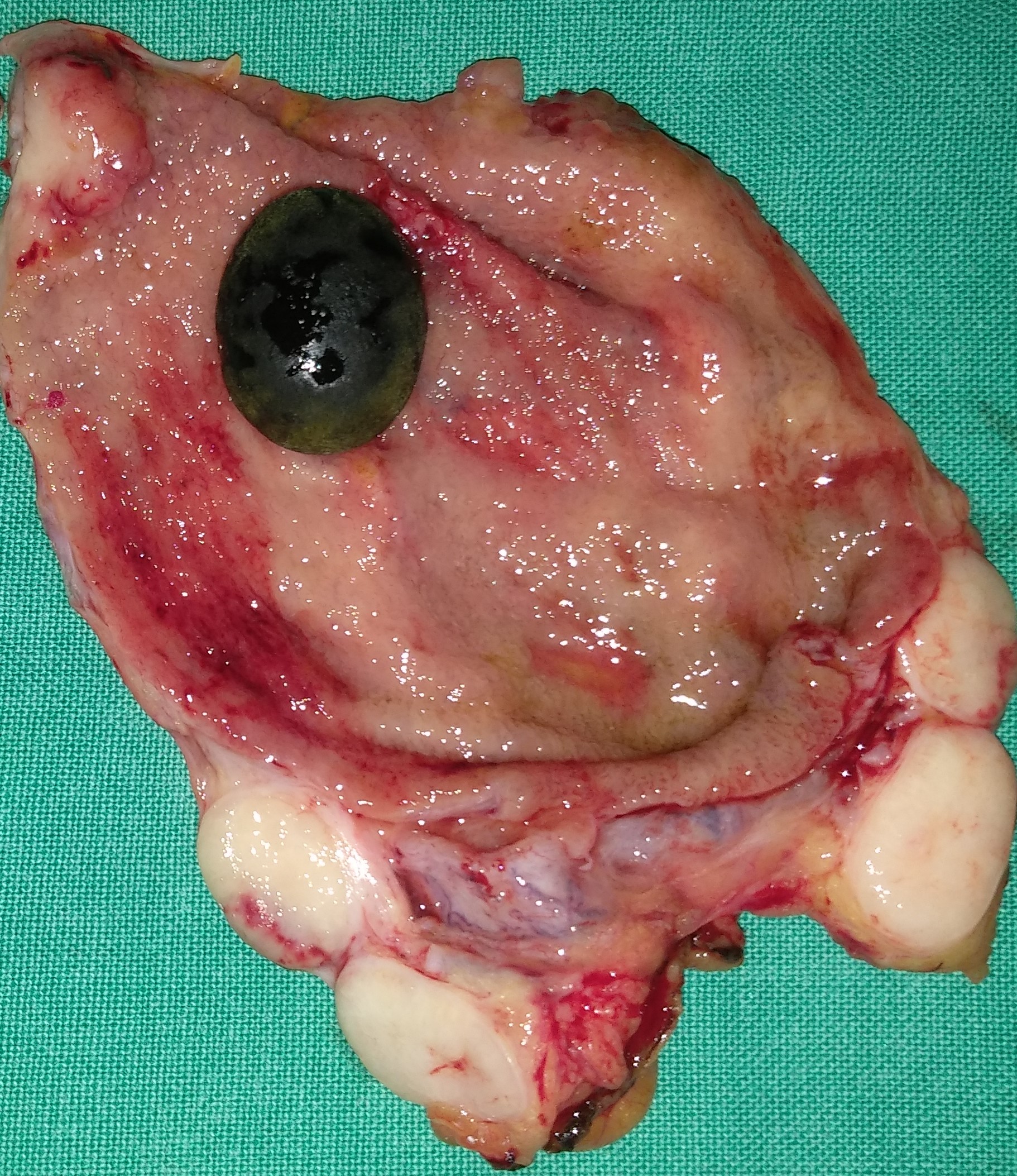 GALLBLADDER CARCINOMA