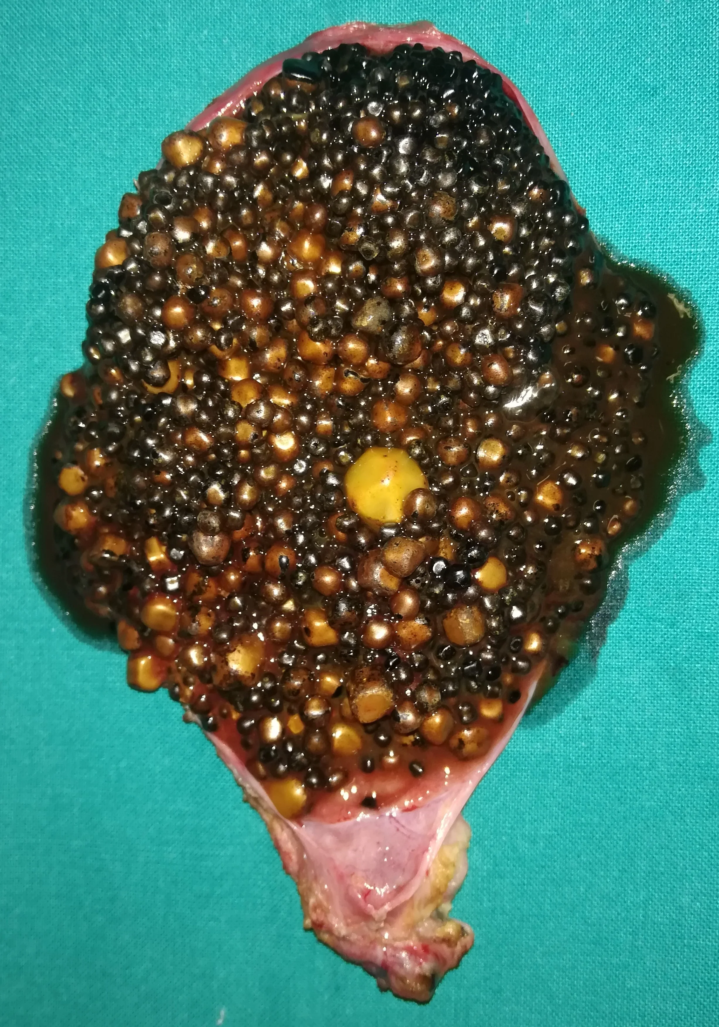 GALLBLADDER BLOCKED BY GALLSTONES. (Courtesy Dr. V.Penopoulos).