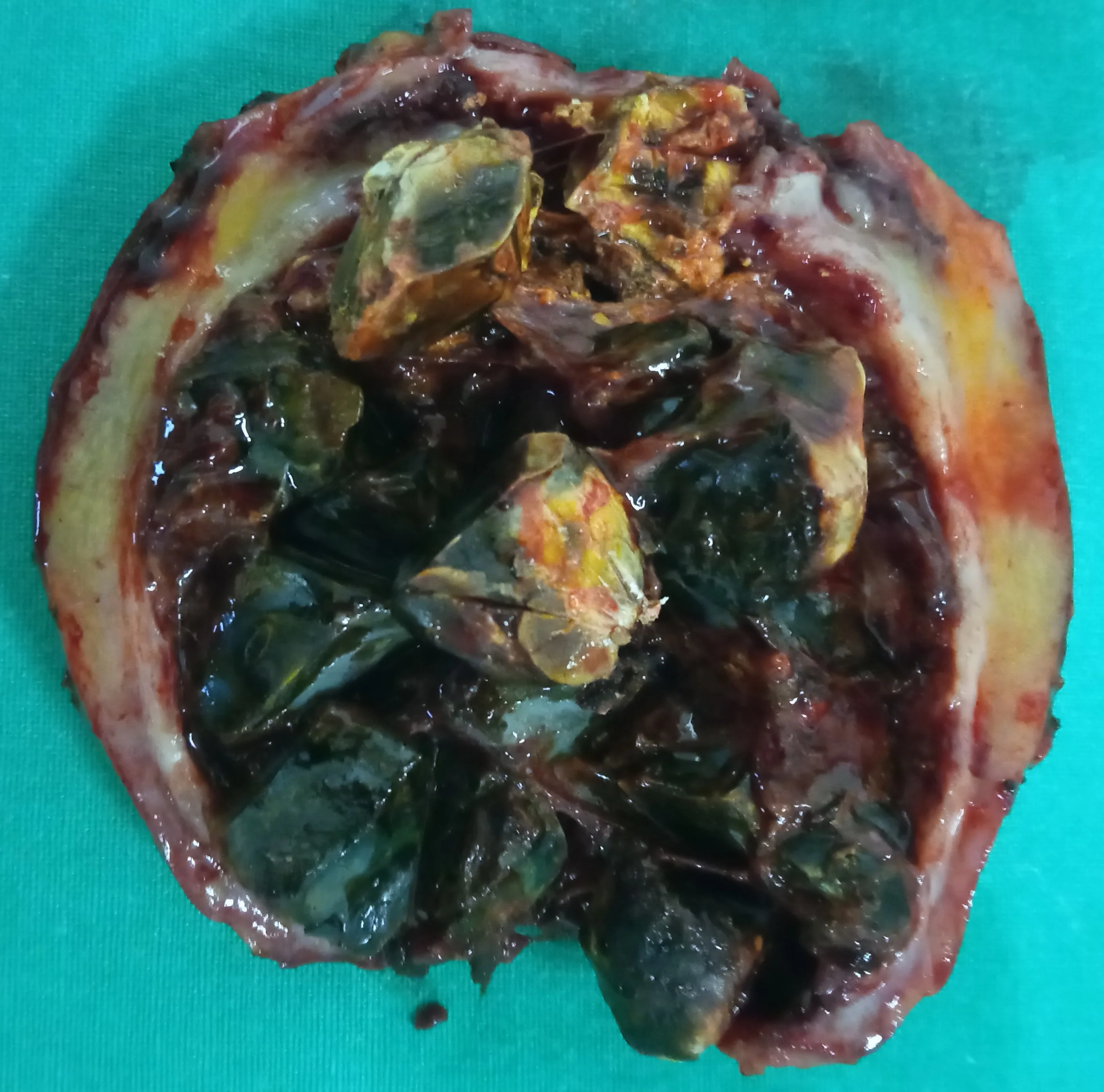 GALLBLADDER IMPACTED WITH GALLSTONES