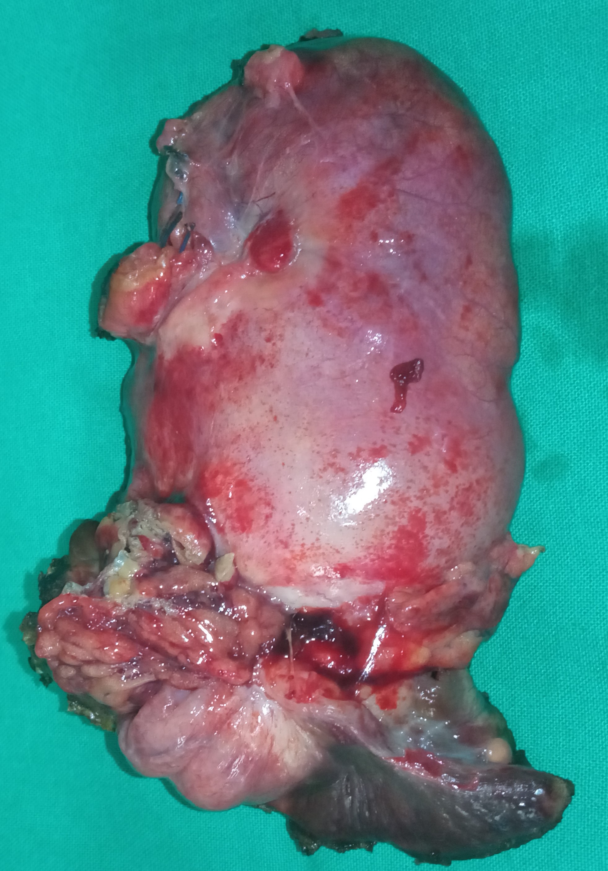 GALLBLADDER CARCINOMA