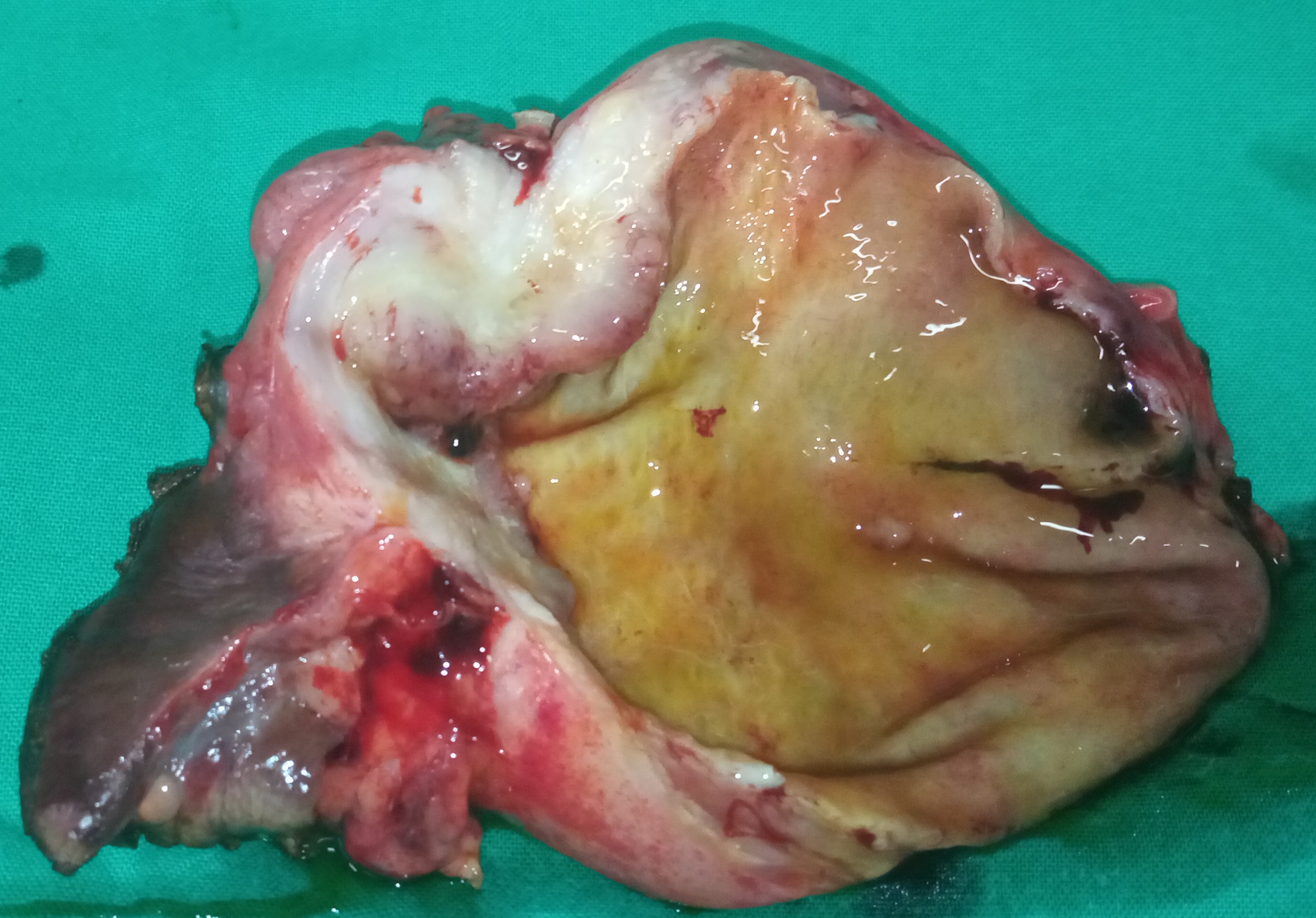 GALLBLADDER CARCINOMA