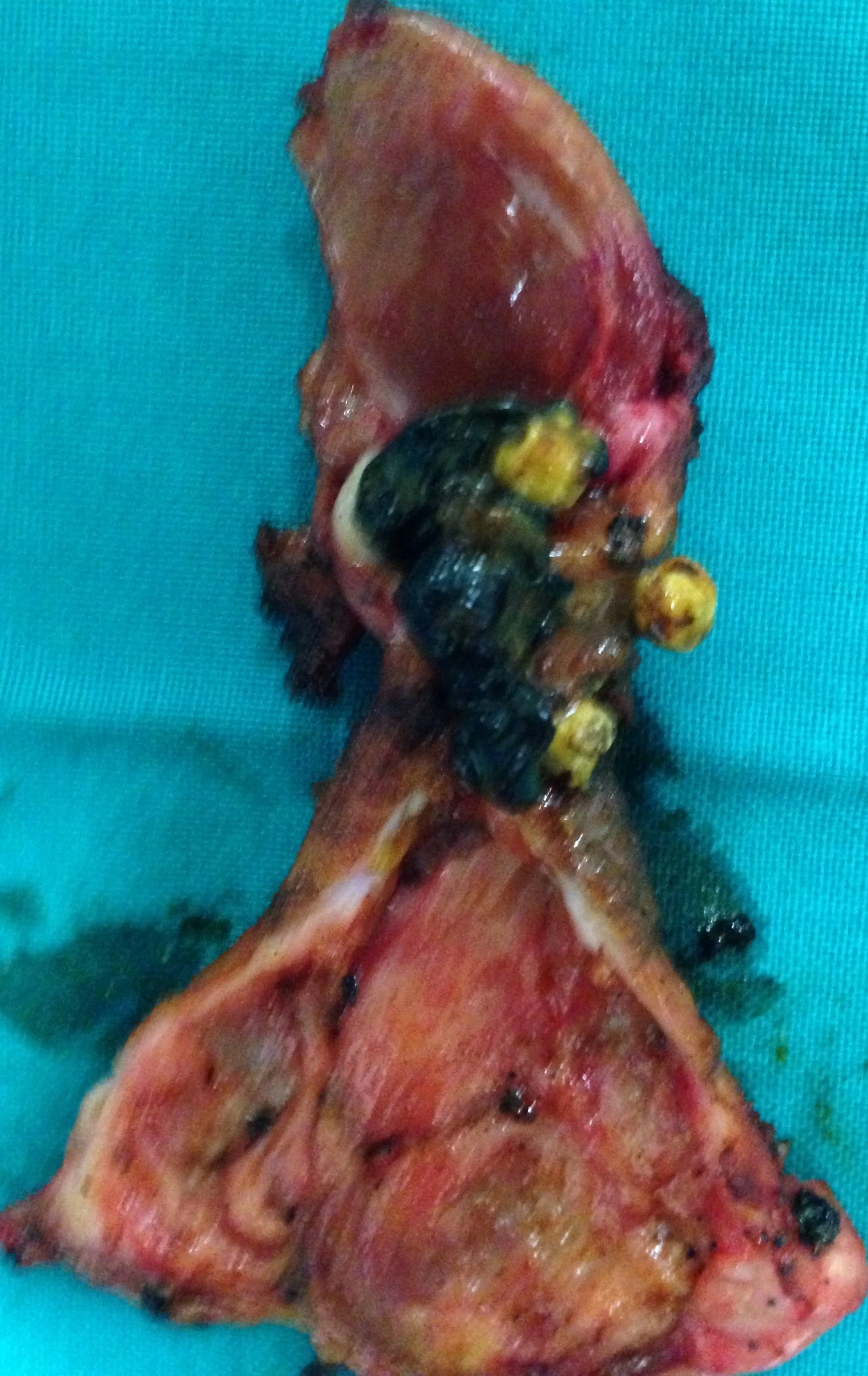 GALLSTONES - ACUTE CHOLECYSTITIS