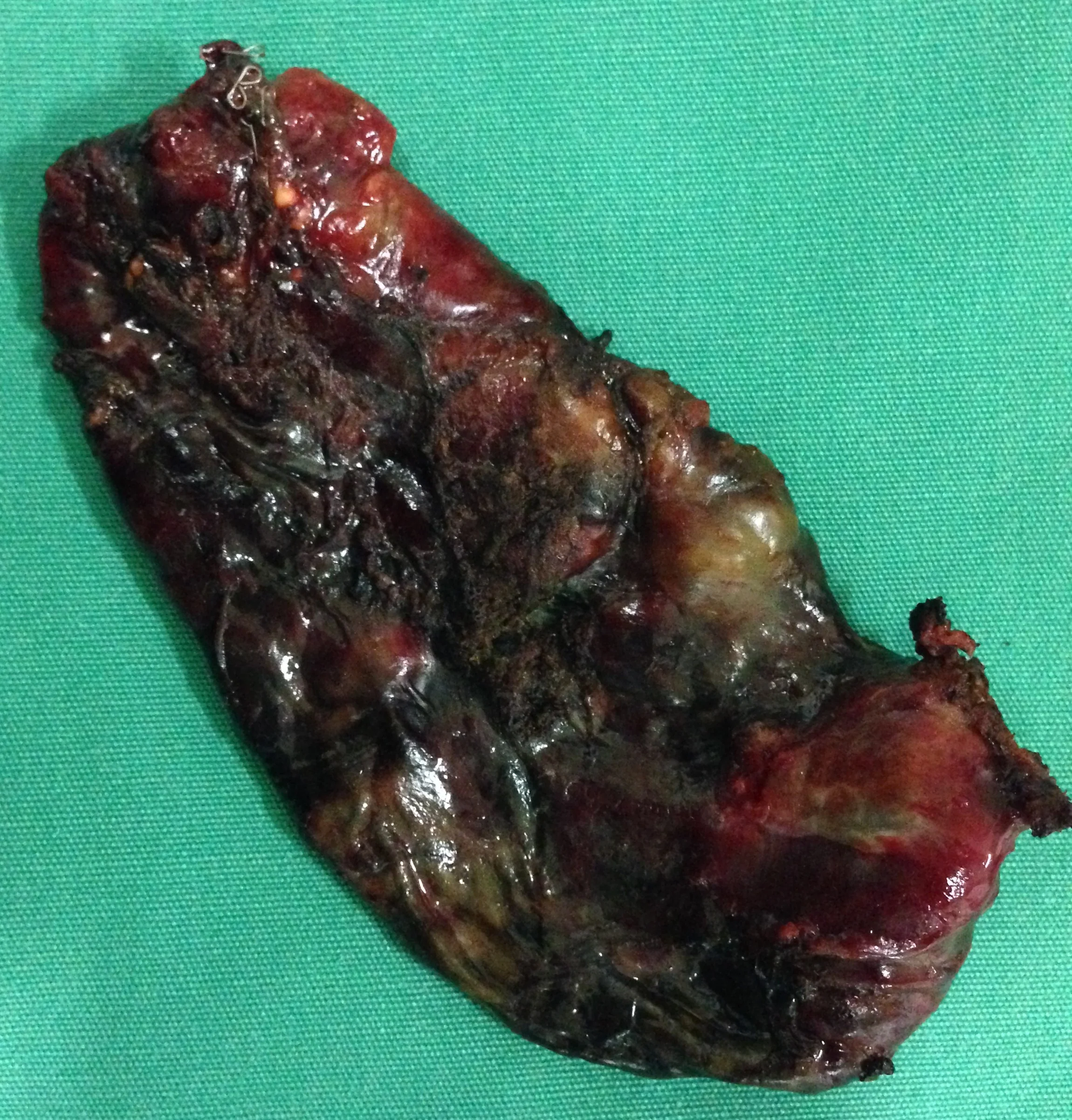 CANGRENOUS CHOLECYSTITIS