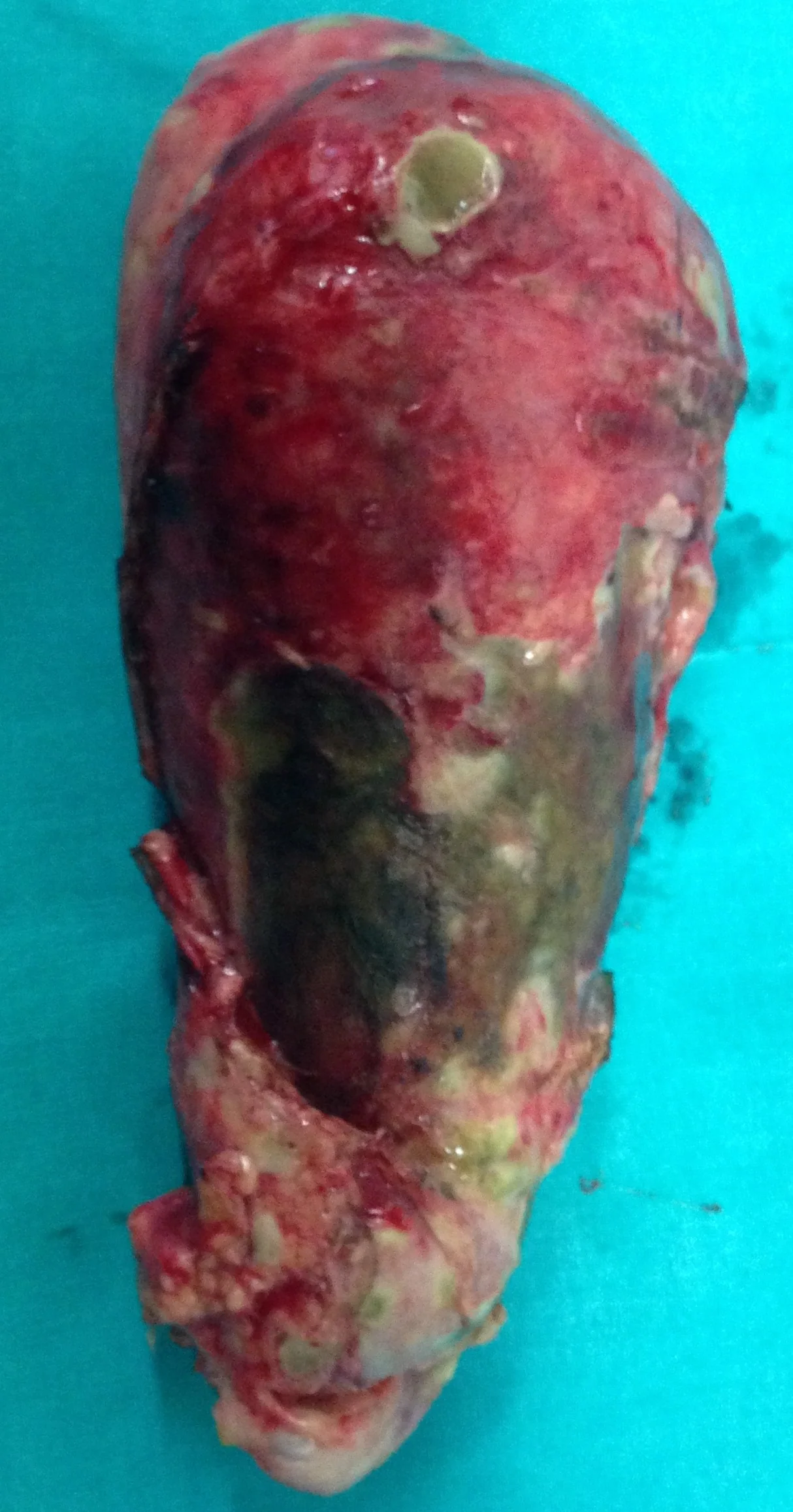 GANGRENOUS CHOLECYSTITIS