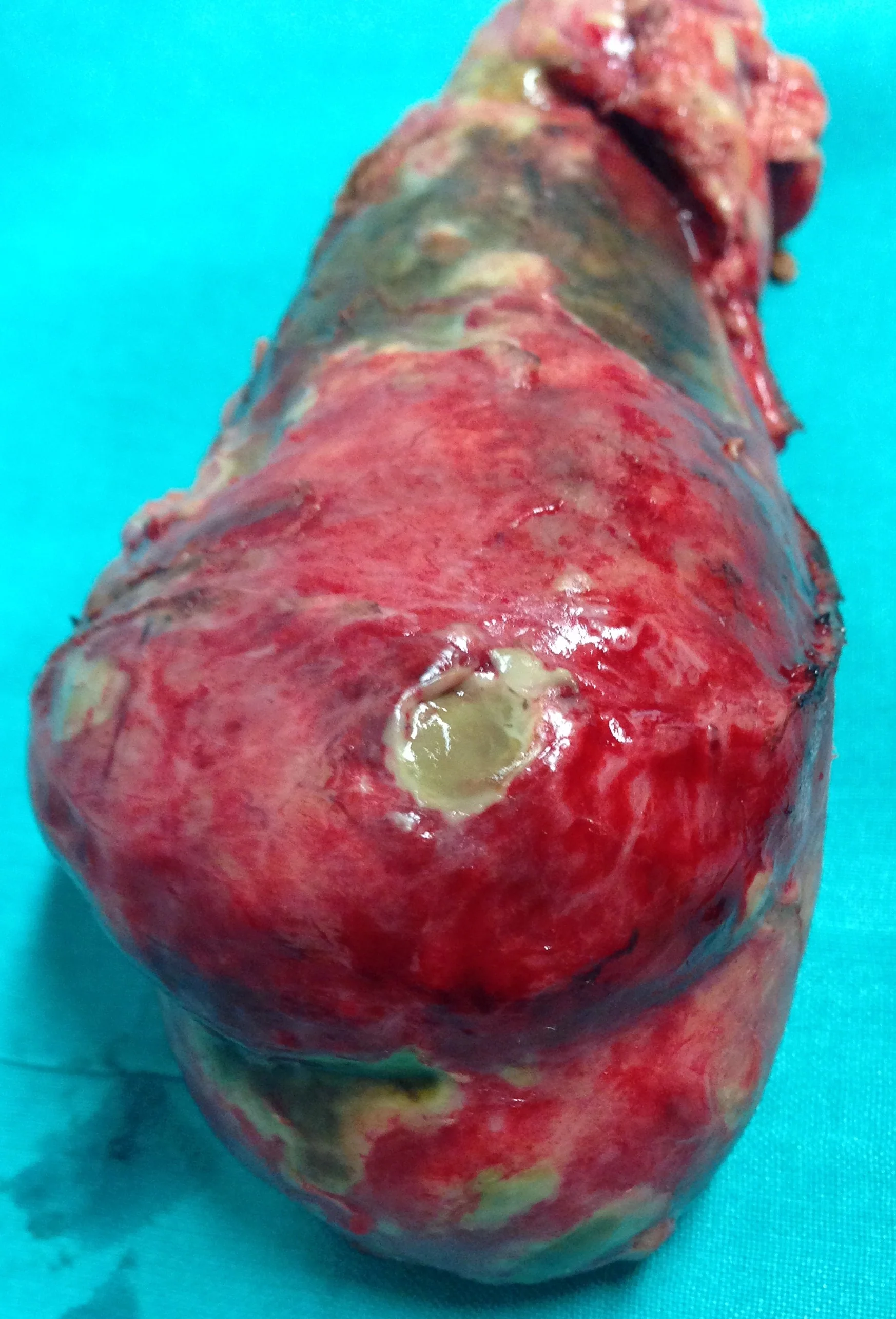 IMPENDING GALLB;ADDER PERFORATION