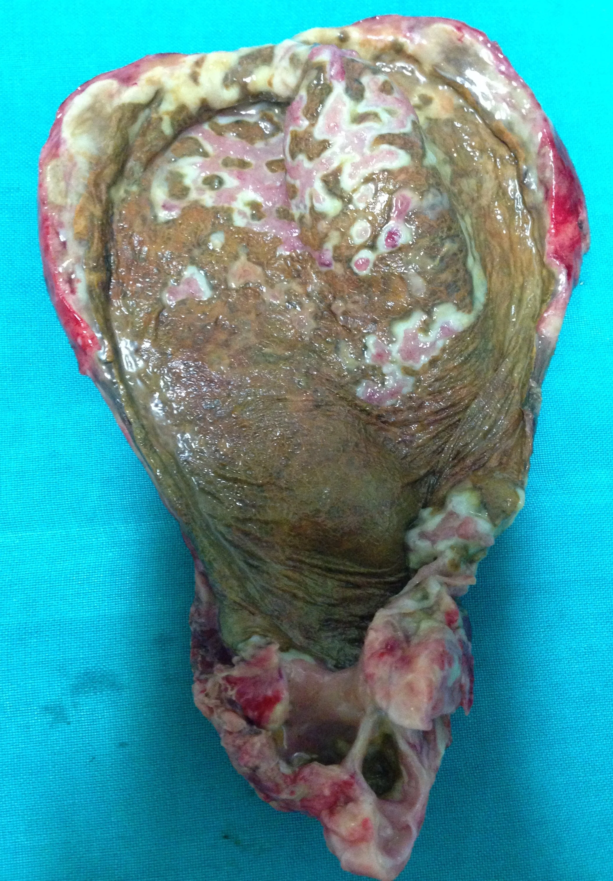 GALLBLADDER MUCOSAL SLOUGHING