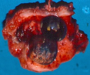 GALLBLADDER CARCINOMA - GALLSTONES