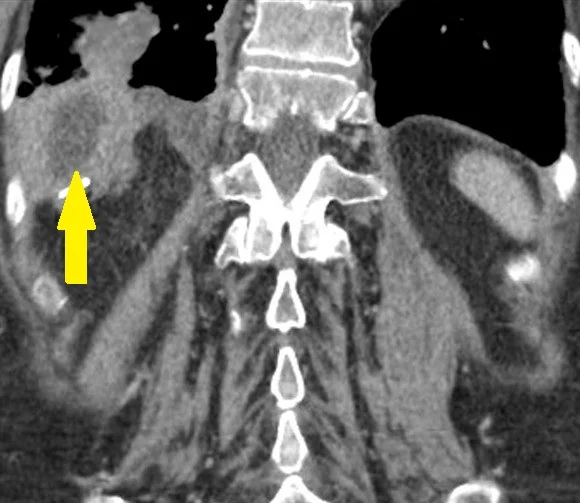 LATE ABSCESS FOLLOWING LAP CHOLECYSTECTOMY