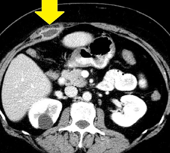LATE ABSCESS FOLLOWING LAP CHOLECYSTECTOMY