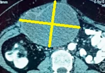 LATE ABSCESS FOLLOWING LAP CHOLECYSTECTOMY