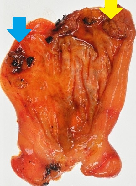 GALLBLADDER MiNEN