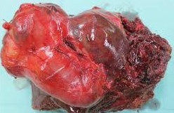 GALLBLADDER MiNEN