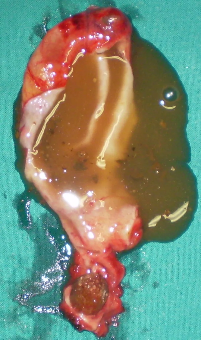 GALLBLADDER NECK OBSTRUCTION