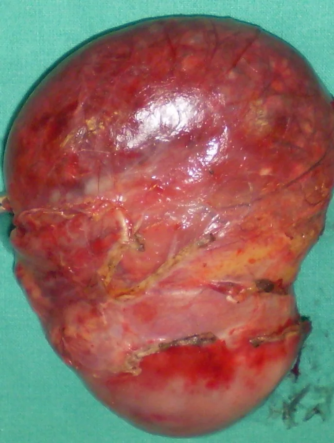 GALLBLADDER HYDROPS