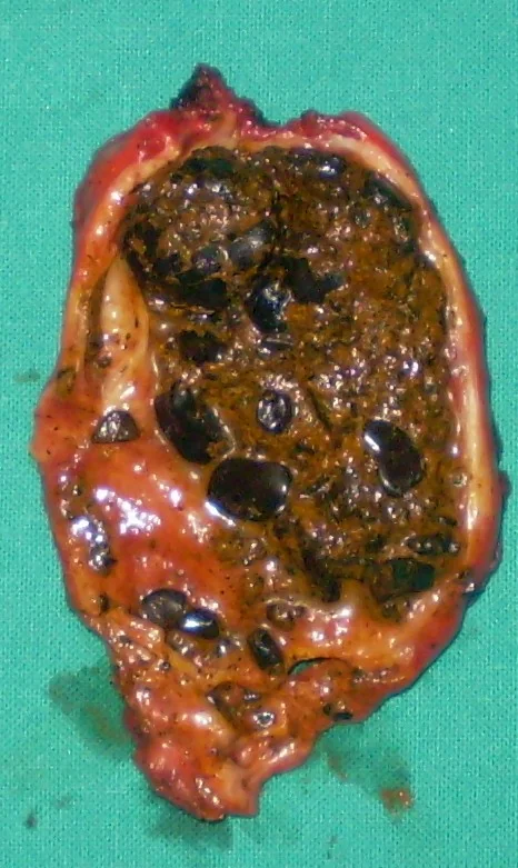 SLUDGE AND GALLSTONES INTERMIXED