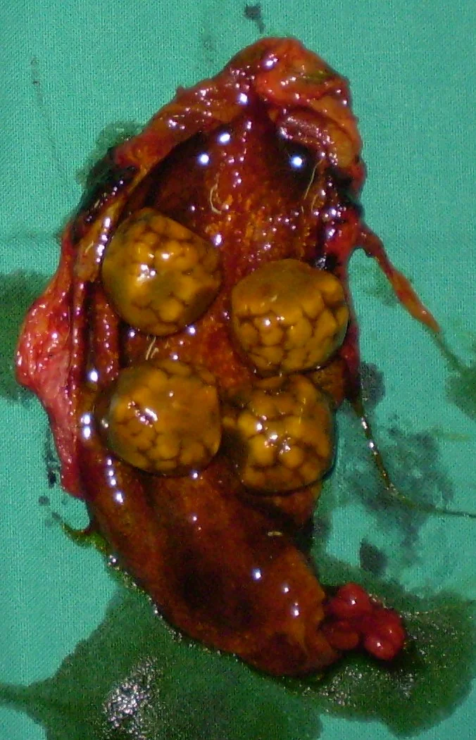 CYPRESS CONE GALLSTONES