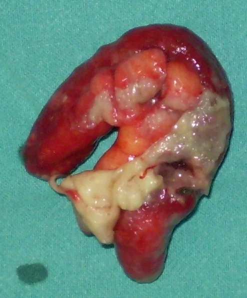 GALLBLADDER PERFORATION