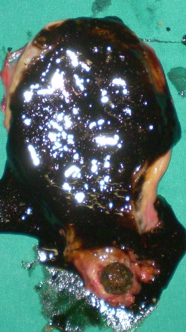 GALLBLADDER IMPACTED WITH SLUDGE
