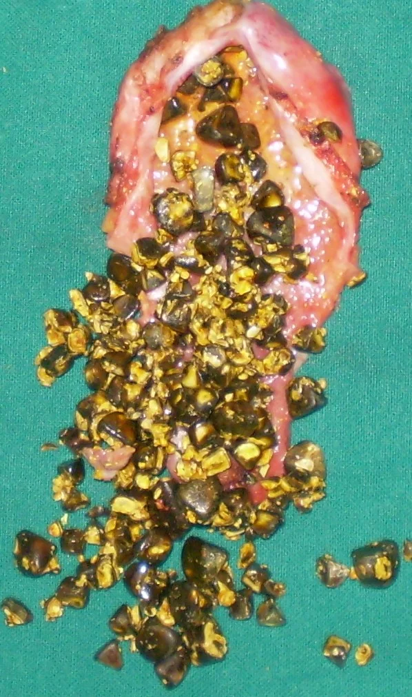 GALLSTONES 
