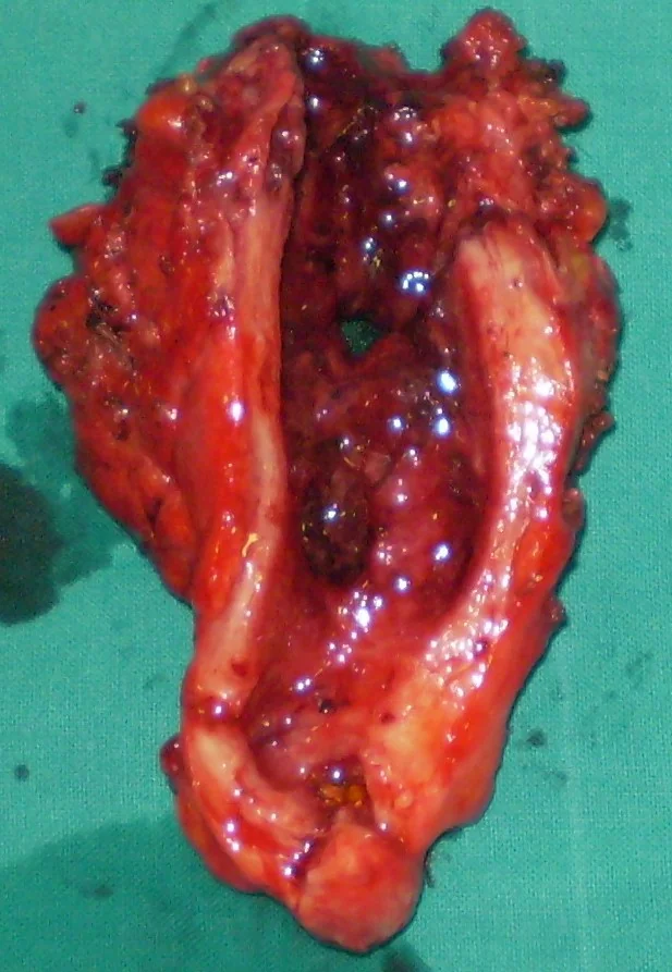 THICKENED GALLBLADDER WALL