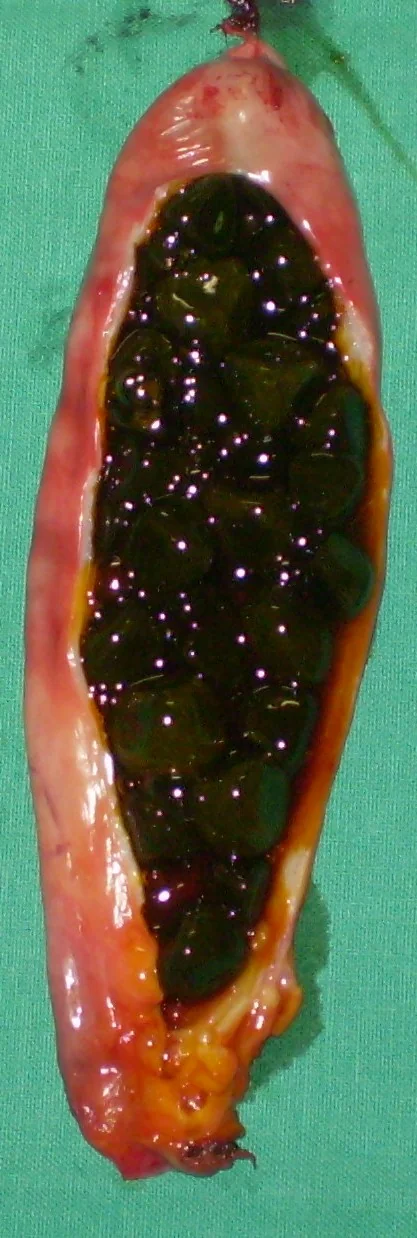 GALLSTONES
