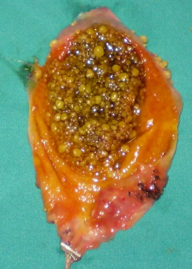 GALLSTONES