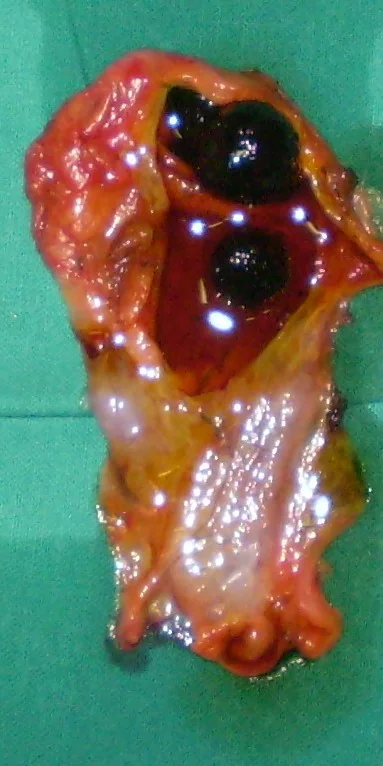 GALLBLADDER DIAPHRAGM