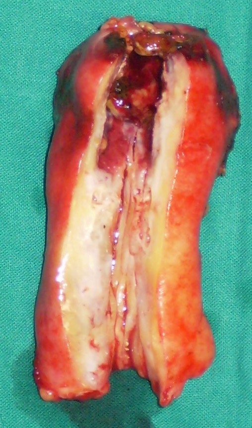 GALLBLADDER CARCINOMA