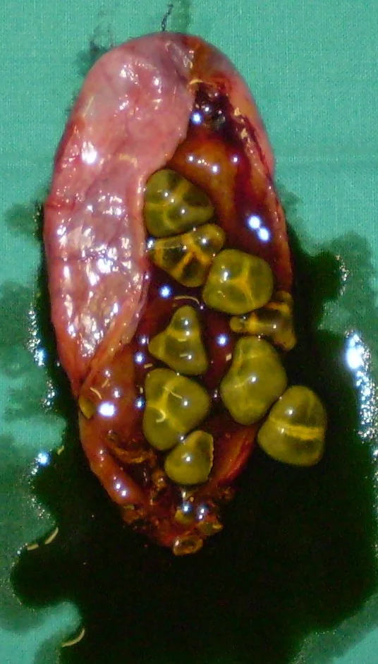 GALLSTONES