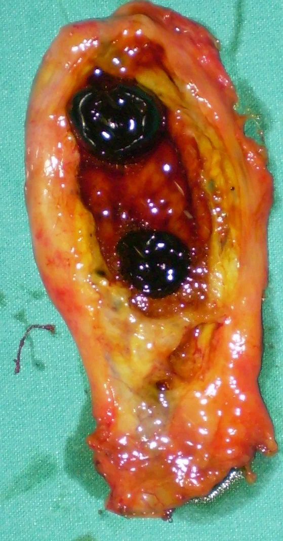 GALLSTONES