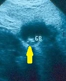 GALLBLADDER POLYP