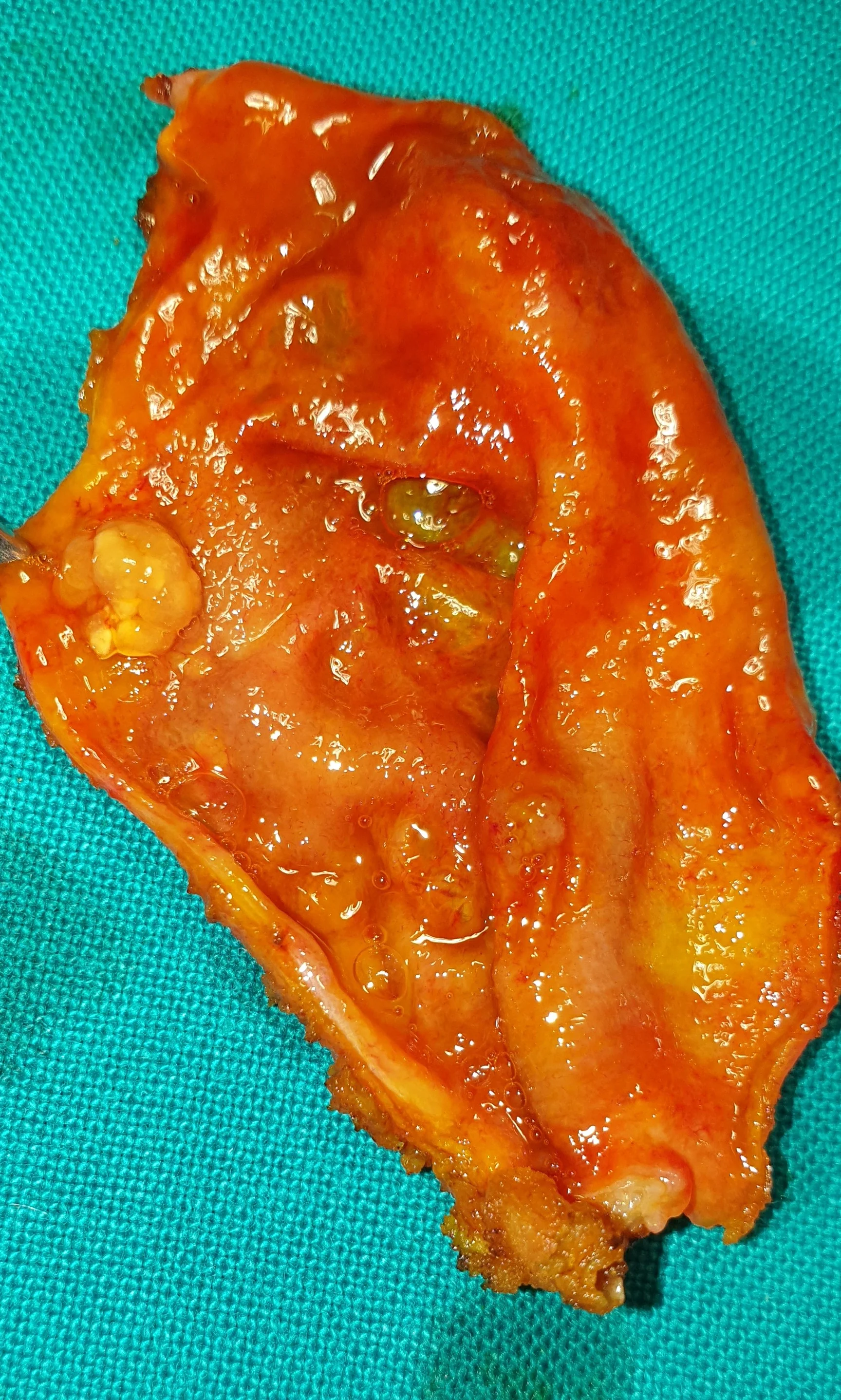 GALLBLADDER POLYP