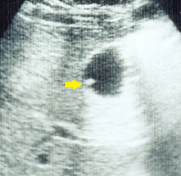 GALLBLADDER POLYP