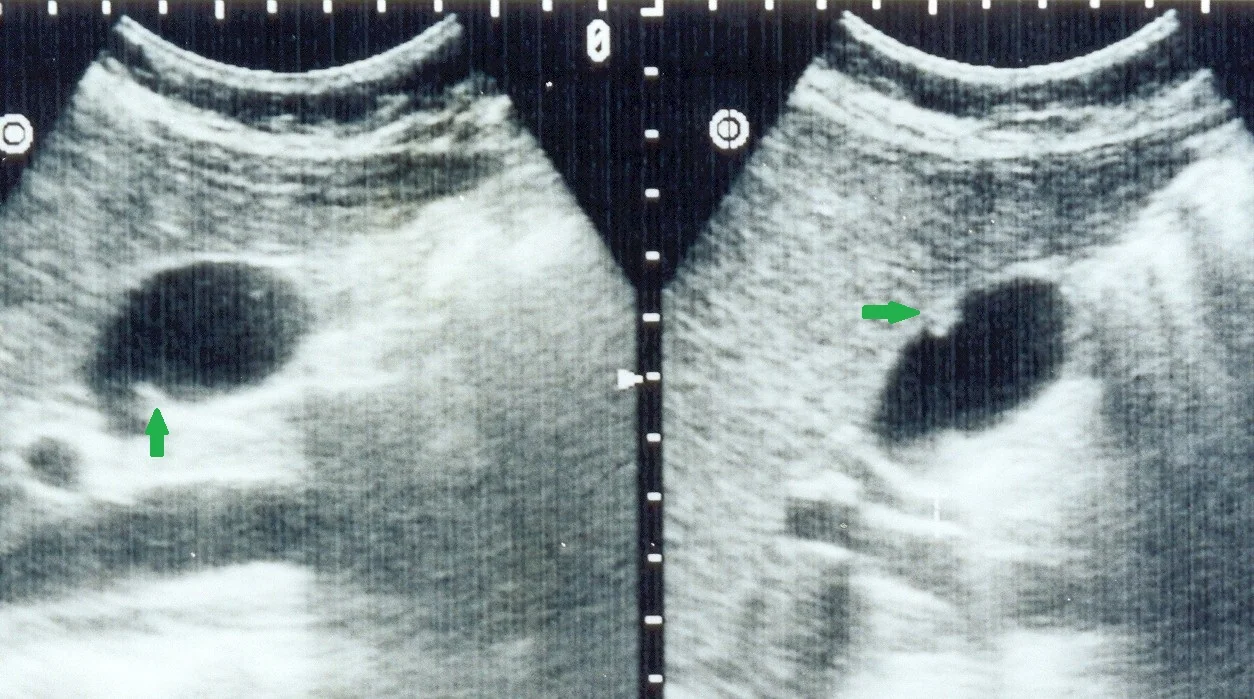 GALLBLADDER POLYPS