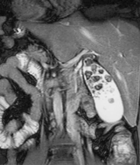 SITUS INVERSUS TOTALIS - GALLSTONES