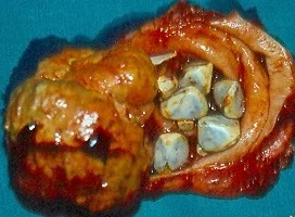 SEVERE INFLAMMATION