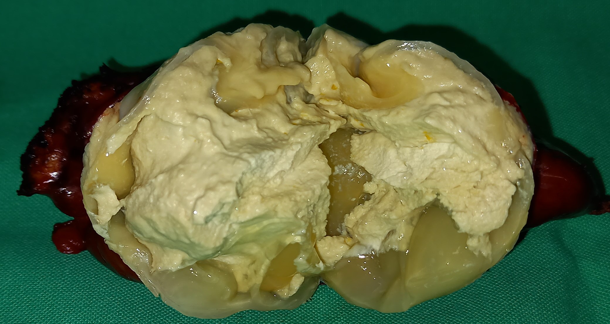EXCISION HYDATID CYST