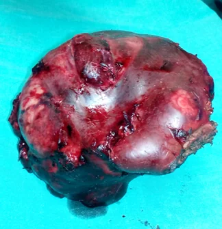 TRI-SEGMENTECTOMY RIGHT HEPATIC LOBE